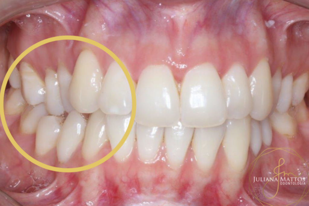 Mordida cruzada posterior – Discrepância transversal