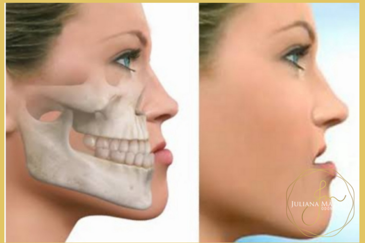 Expansão maxilar: quando é necessário? - Academia da Odontologia