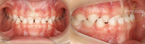 Excesso mandibular - Deficiência maxilar - Classe III - Dra