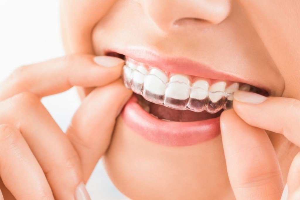 Quanto custa o Invisalign?